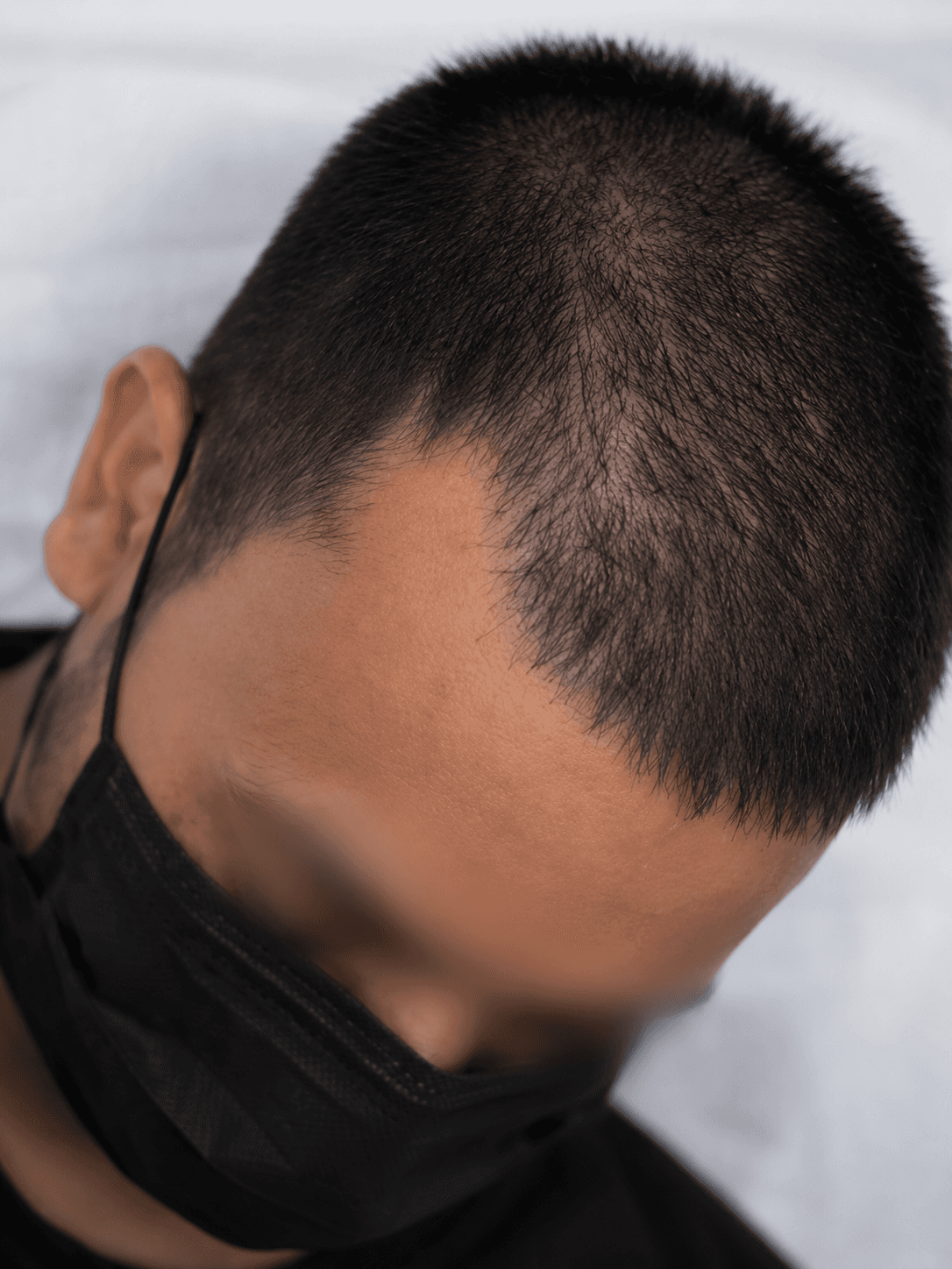 Hair Regrowth — after treatment