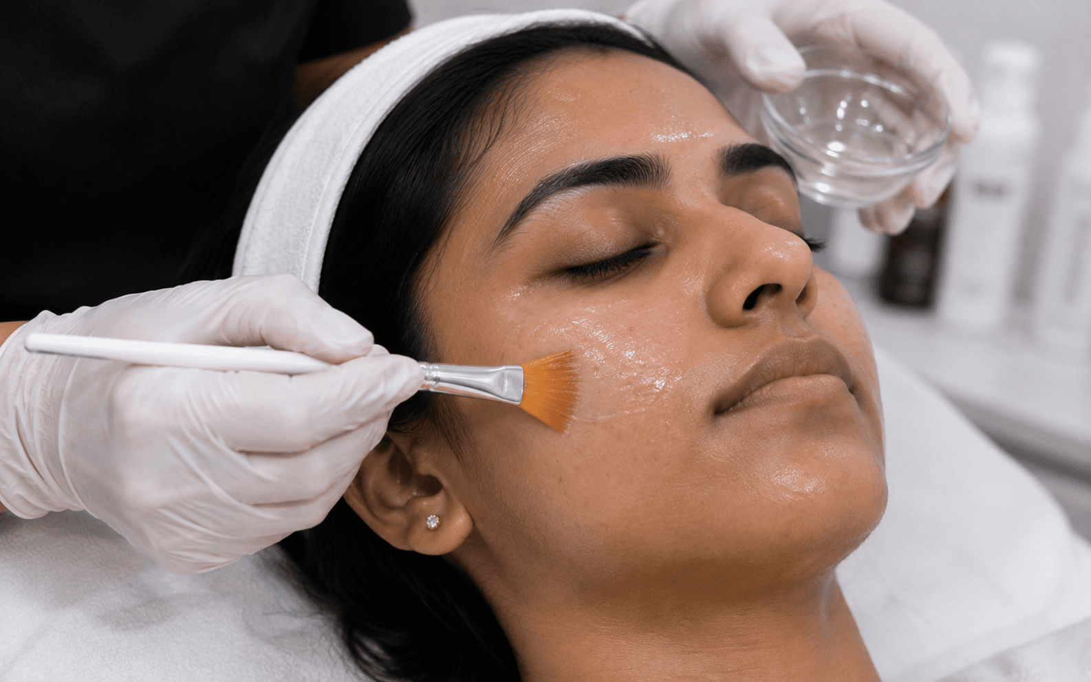 Chemical Peels