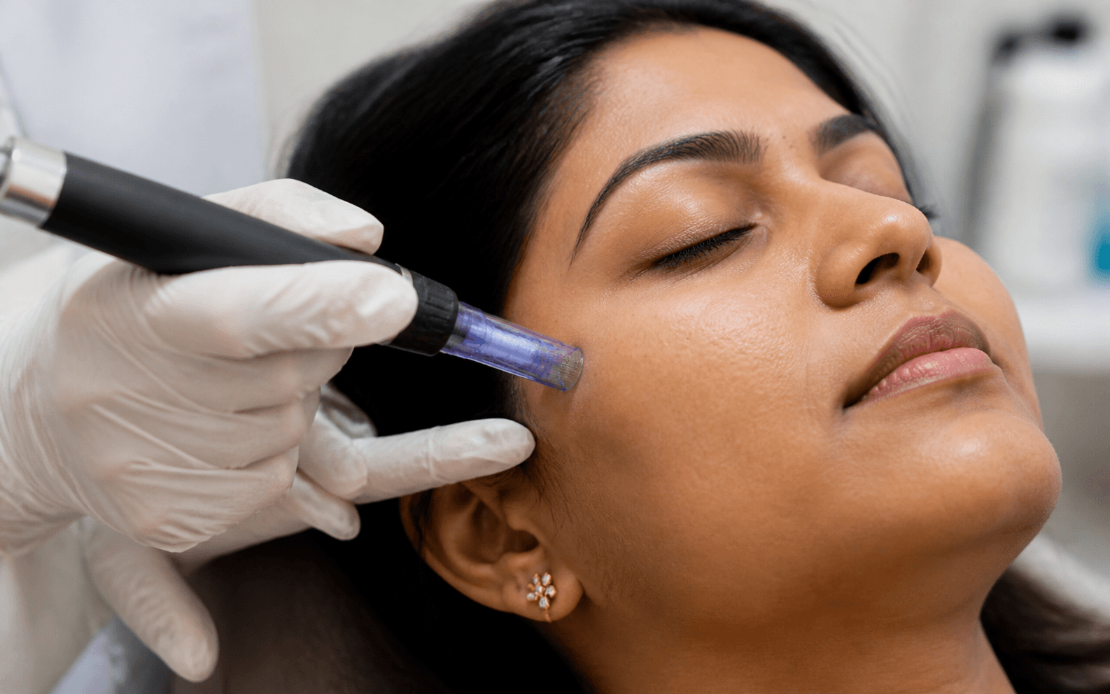 Collagen Induction Therapy