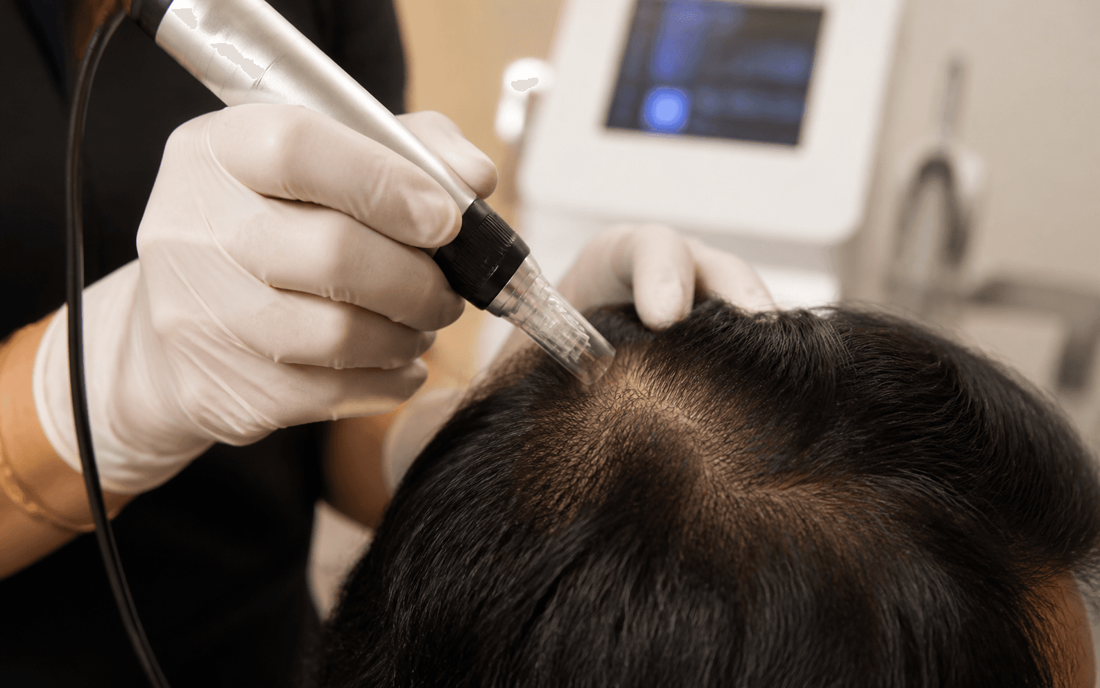 Microneedling for Hair Loss