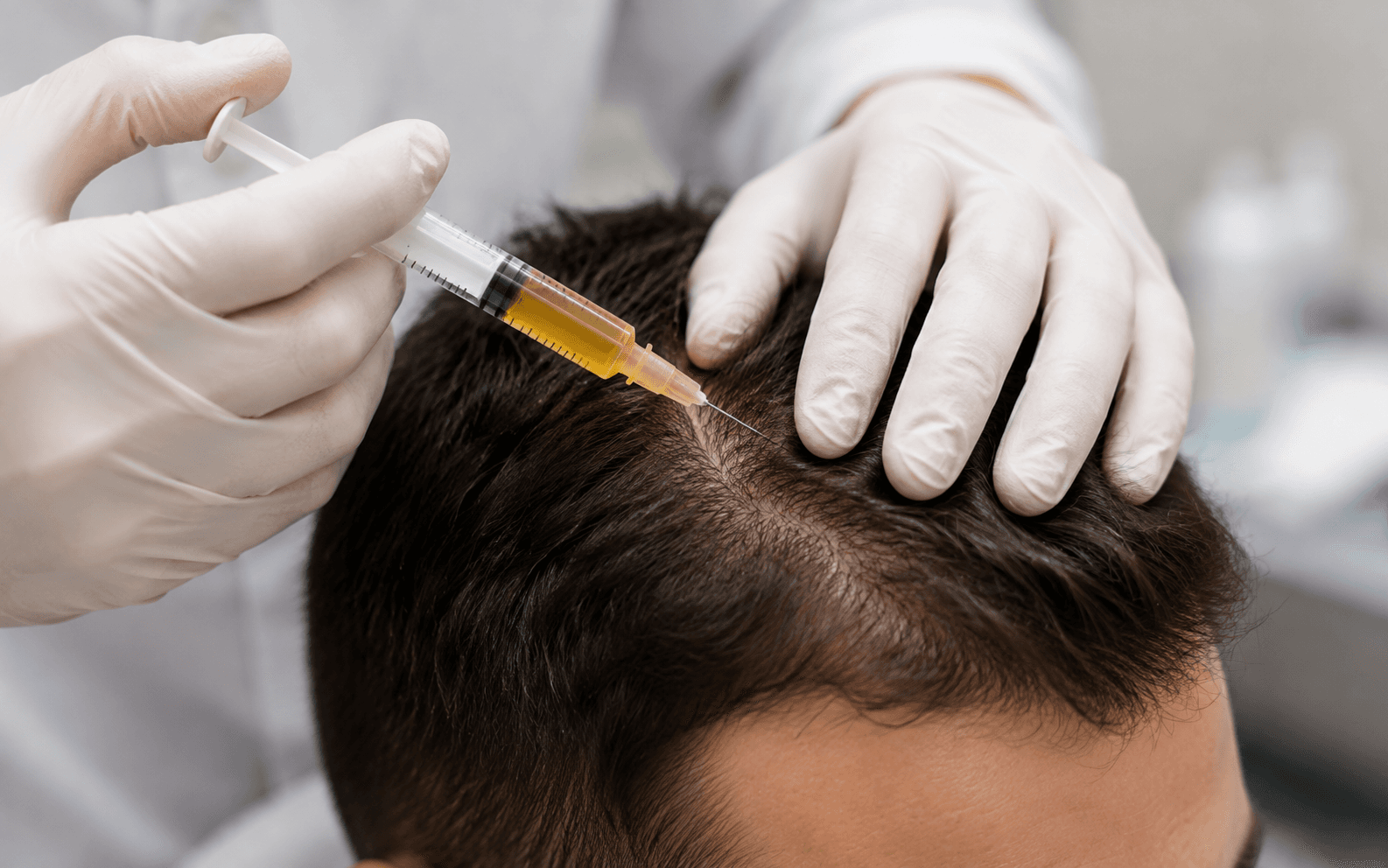 PRP Hair Therapy